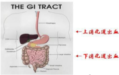 上消化道出血能自愈吗,上消化道出血的自愈可能性及影响因素